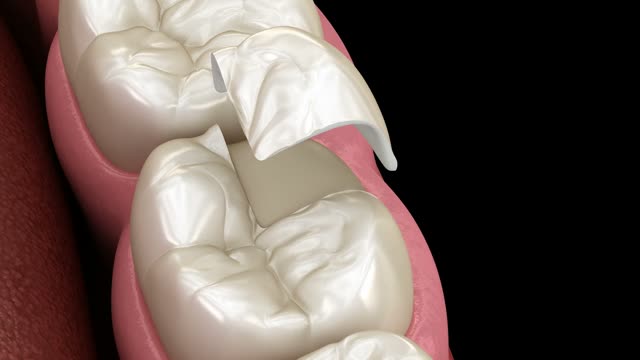 Crown on a molar animation