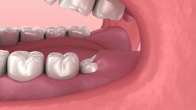 Wisdom tooth removal animation